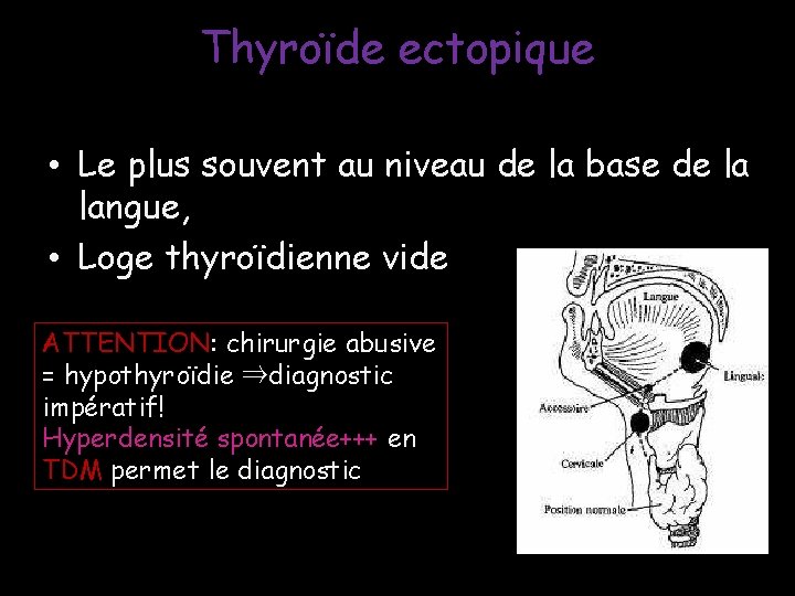 Thyroïde ectopique • Le plus souvent au niveau de la base de la langue, Thyroïde ectopique • Le plus souvent au niveau de la base de la langue,