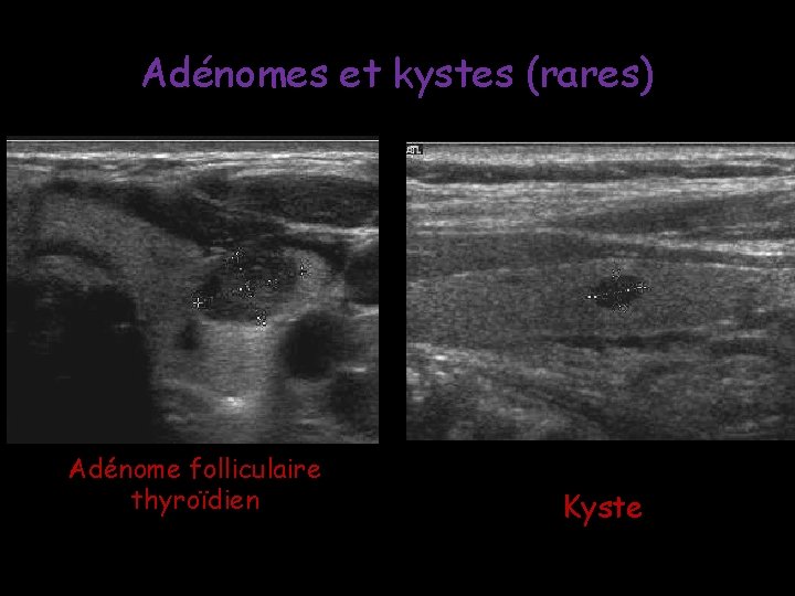 Adénomes et kystes (rares) Adénome folliculaire thyroïdien Kyste Adénomes et kystes (rares) Adénome folliculaire thyroïdien Kyste