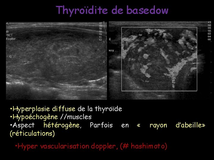 Thyroïdite de basedow • Hyperplasie diffuse de la thyroïde • Hypoéchogène //muscles • Aspect Thyroïdite de basedow • Hyperplasie diffuse de la thyroïde • Hypoéchogène //muscles • Aspect