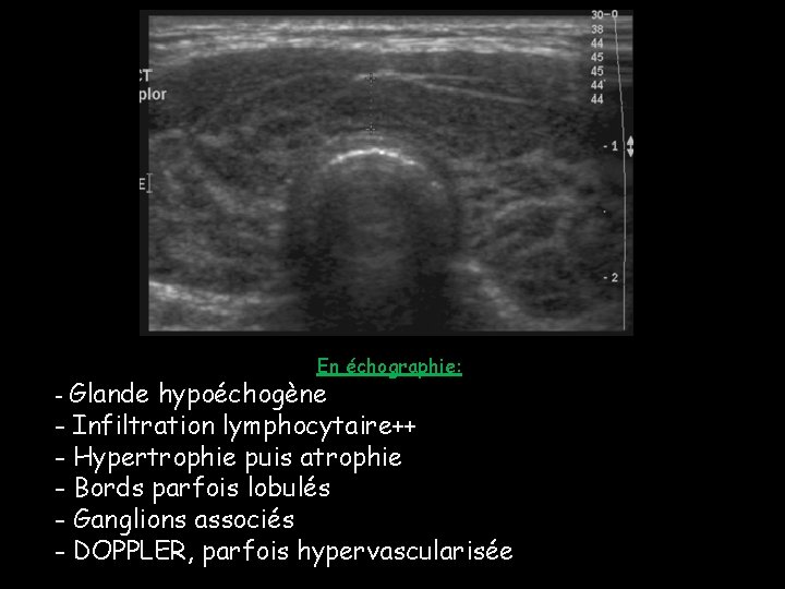 - Glande En échographie: hypoéchogène - Infiltration lymphocytaire++ - Hypertrophie puis atrophie - Bords - Glande En échographie: hypoéchogène - Infiltration lymphocytaire++ - Hypertrophie puis atrophie - Bords
