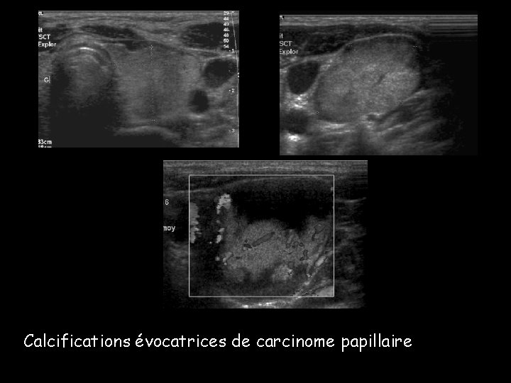Calcifications évocatrices de carcinome papillaire Calcifications évocatrices de carcinome papillaire