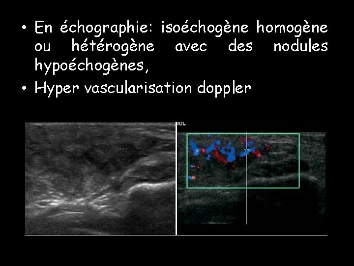 • En échographie: isoéchogène homogène ou hétérogène avec des nodules hypoéchogènes, • Hyper • En échographie: isoéchogène homogène ou hétérogène avec des nodules hypoéchogènes, • Hyper