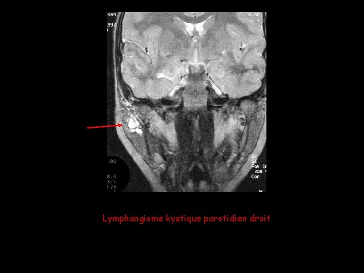Lymphangiome kystique parotidien droit Lymphangiome kystique parotidien droit