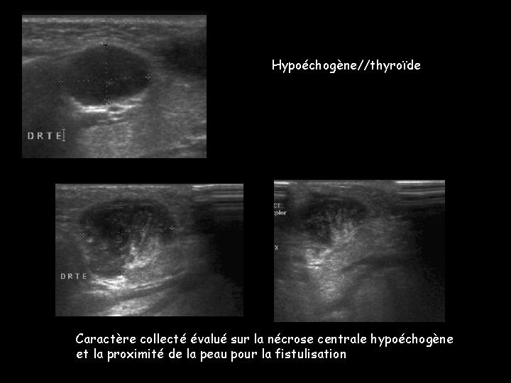 Hypoéchogène//thyroïde Caractère collecté évalué sur la nécrose centrale hypoéchogène et la proximité de la Hypoéchogène//thyroïde Caractère collecté évalué sur la nécrose centrale hypoéchogène et la proximité de la
