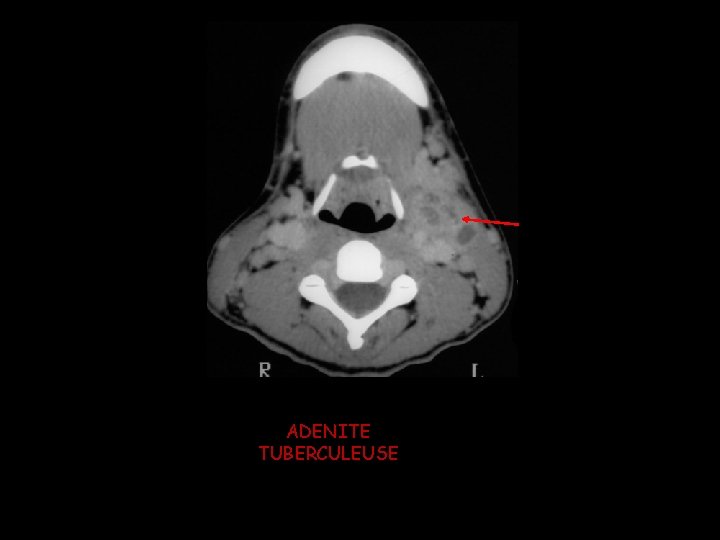 ADENITE TUBERCULEUSE ADENITE TUBERCULEUSE