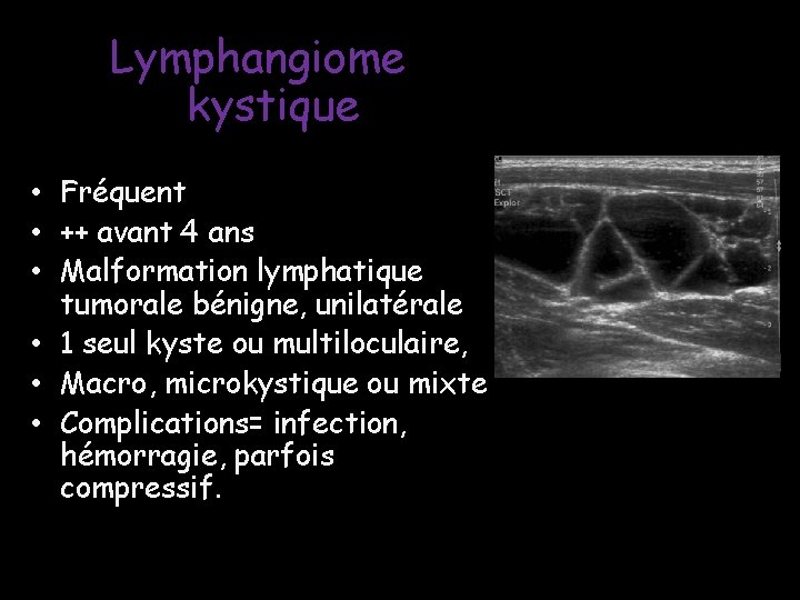Lymphangiome kystique • Fréquent • ++ avant 4 ans • Malformation lymphatique tumorale bénigne, Lymphangiome kystique • Fréquent • ++ avant 4 ans • Malformation lymphatique tumorale bénigne,