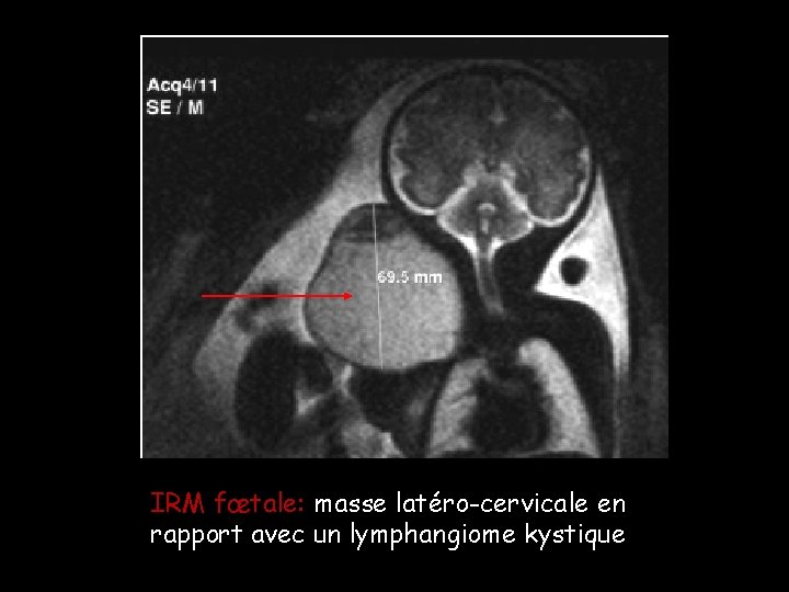 IRM fœtale: masse latéro-cervicale en rapport avec un lymphangiome kystique IRM fœtale: masse latéro-cervicale en rapport avec un lymphangiome kystique