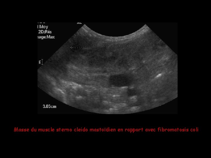 Masse du muscle sterno cleido mastoïdien en rapport avec fibromatosis coli Masse du muscle sterno cleido mastoïdien en rapport avec fibromatosis coli