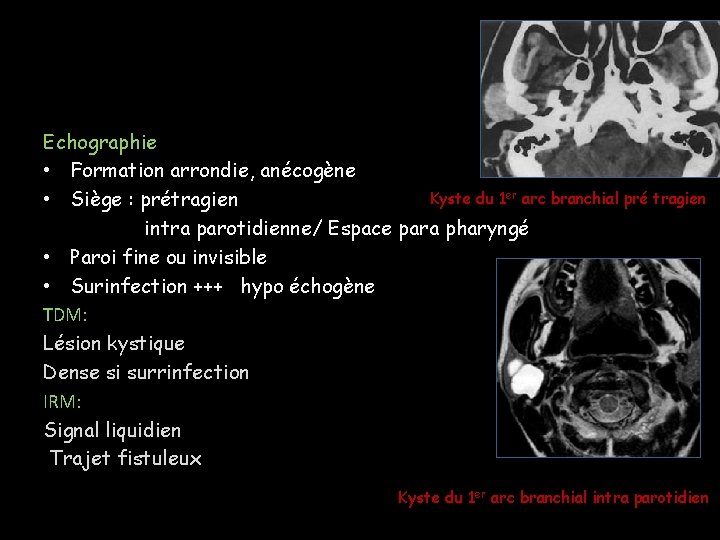 Echographie • Formation arrondie, anécogène Kyste du 1 er arc branchial pré tragien • Echographie • Formation arrondie, anécogène Kyste du 1 er arc branchial pré tragien •
