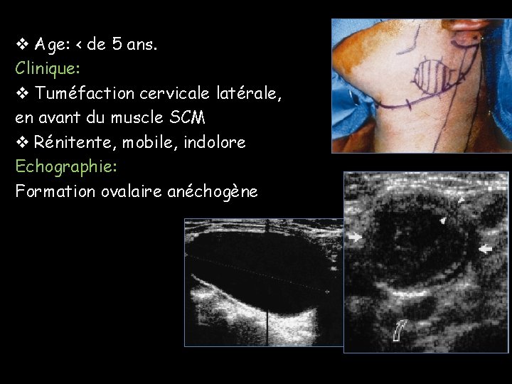 v Age: < de 5 ans. Clinique: v Tuméfaction cervicale latérale, en avant du v Age: < de 5 ans. Clinique: v Tuméfaction cervicale latérale, en avant du