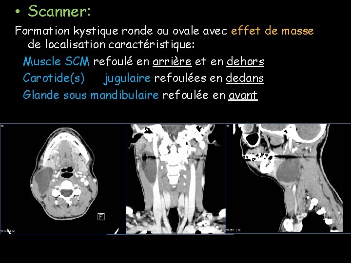 • Scanner: Formation kystique ronde ou ovale avec effet de masse, de localisation • Scanner: Formation kystique ronde ou ovale avec effet de masse, de localisation