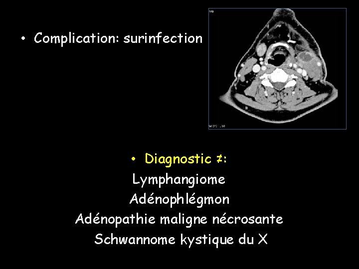• Complication: surinfection • Diagnostic ≠: Lymphangiome Adénophlégmon Adénopathie maligne nécrosante Schwannome kystique • Complication: surinfection • Diagnostic ≠: Lymphangiome Adénophlégmon Adénopathie maligne nécrosante Schwannome kystique