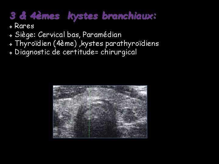 3 & 4èmes kystes branchiaux: Rares v Siège: Cervical bas, Paramédian v Thyroïdien (4ème) 3 & 4èmes kystes branchiaux: Rares v Siège: Cervical bas, Paramédian v Thyroïdien (4ème)