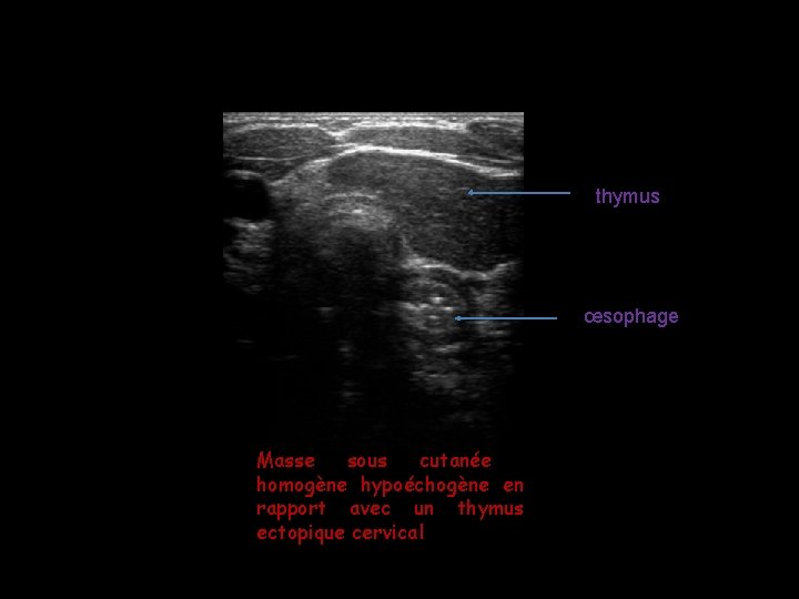 thymus œsophage Masse sous cutanée homogène hypoéchogène en rapport avec un thymus ectopique cervical thymus œsophage Masse sous cutanée homogène hypoéchogène en rapport avec un thymus ectopique cervical