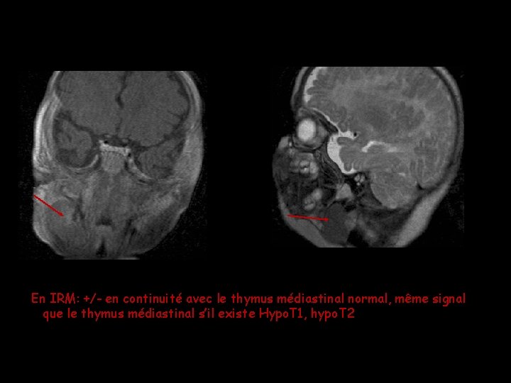 En IRM: +/- en continuité avec le thymus médiastinal normal, même signal que le En IRM: +/- en continuité avec le thymus médiastinal normal, même signal que le