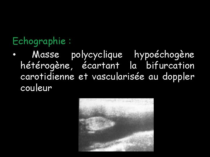 Echographie : • Masse polycyclique hypoéchogène hétérogène, écartant la bifurcation carotidienne et vascularisée au Echographie : • Masse polycyclique hypoéchogène hétérogène, écartant la bifurcation carotidienne et vascularisée au