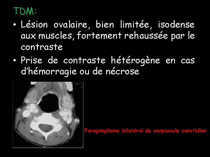 TDM: • Lésion ovalaire, bien limitée, isodense aux muscles, fortement rehaussée par le contraste TDM: • Lésion ovalaire, bien limitée, isodense aux muscles, fortement rehaussée par le contraste