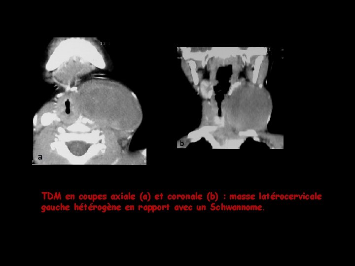 TDM en coupes axiale (a) et coronale (b) : masse latérocervicale gauche hétérogène en TDM en coupes axiale (a) et coronale (b) : masse latérocervicale gauche hétérogène en