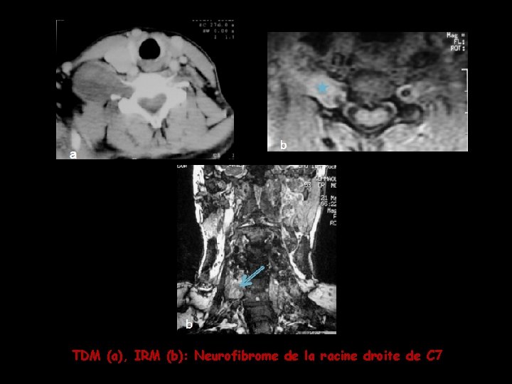 TDM (a), IRM (b): Neurofibrome de la racine droite de C 7 TDM (a), IRM (b): Neurofibrome de la racine droite de C 7