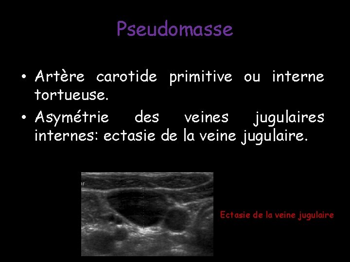 Pseudomasse • Artère carotide primitive ou interne tortueuse. • Asymétrie des veines jugulaires internes: Pseudomasse • Artère carotide primitive ou interne tortueuse. • Asymétrie des veines jugulaires internes: