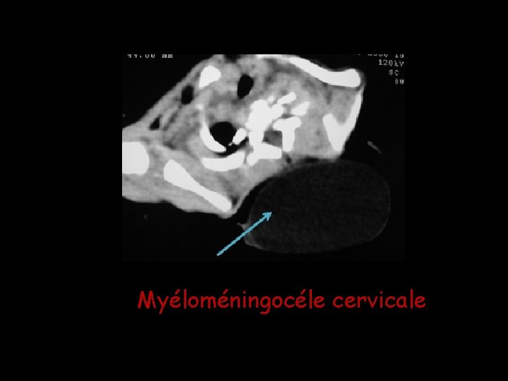 Myéloméningocéle cervicale Myéloméningocéle cervicale