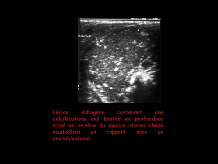 Lésion échogène contenant des calcifications mal limitée en profondeur situé en arrière du muscle Lésion échogène contenant des calcifications mal limitée en profondeur situé en arrière du muscle