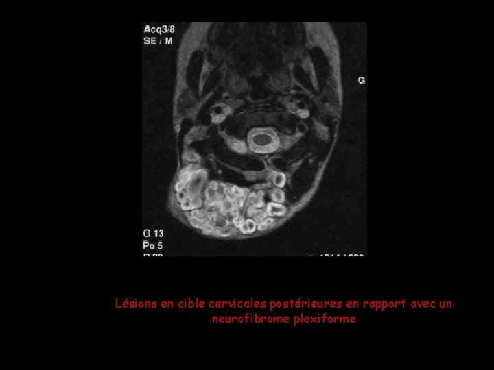 Lésions en cible cervicales postérieures en rapport avec un neurofibrome plexiforme Lésions en cible cervicales postérieures en rapport avec un neurofibrome plexiforme