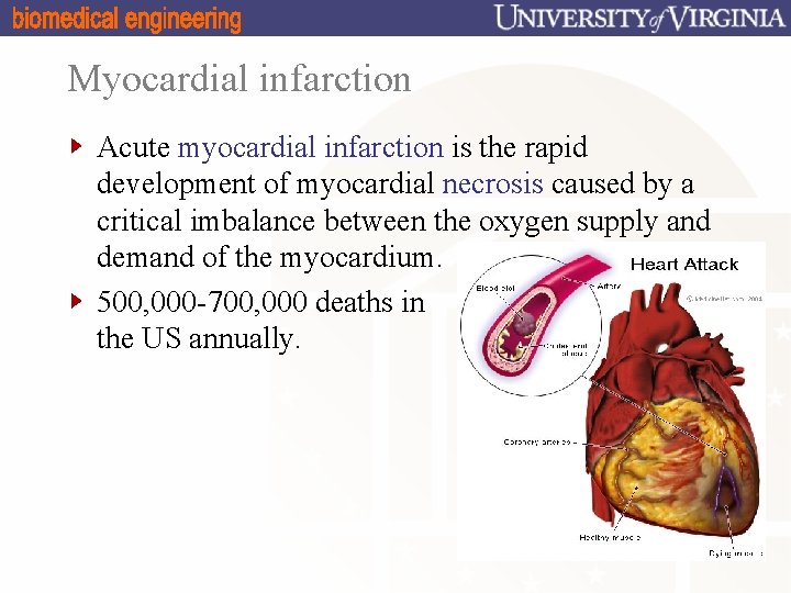 Myocardial infarction Acute myocardial infarction is the rapid development of myocardial necrosis caused by