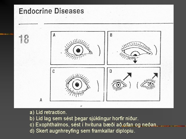 a) Lid retraction. b) Lid lag sem sést þegar sjúklingur horfir niður. c) Exophthalmos,