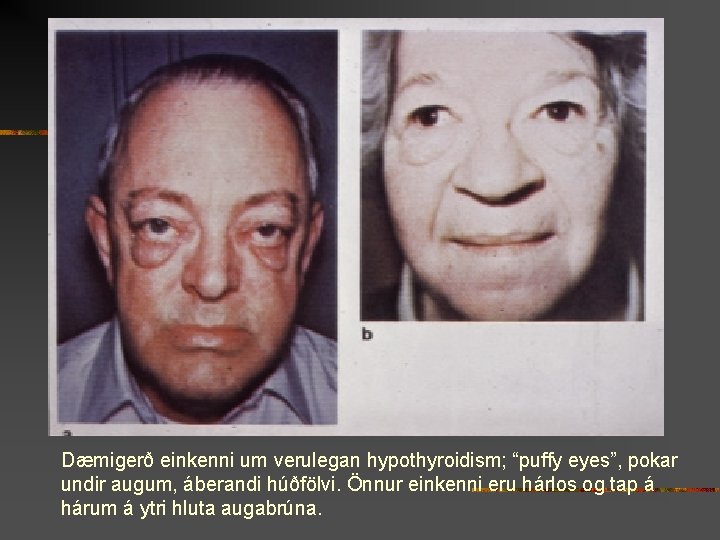 Dæmigerð einkenni um verulegan hypothyroidism; “puffy eyes”, pokar undir augum, áberandi húðfölvi. Önnur einkenni