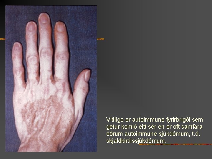 Vitiligo er autoimmune fyrirbrigði sem getur komið eitt sér en er oft samfara öðrum