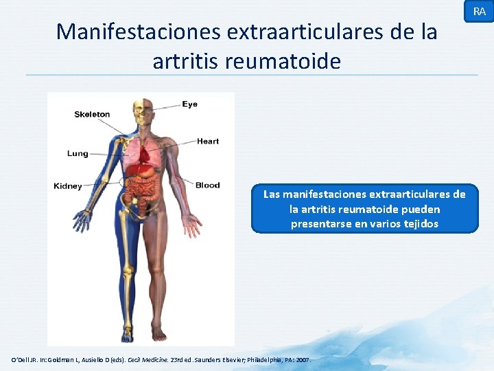 Manifestaciones extraarticulares de la artritis reumatoide Las manifestaciones extraarticulares de la artritis reumatoide pueden