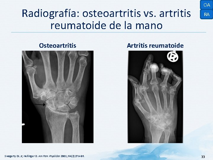 Radiografía: osteoartritis vs. artritis reumatoide de la mano Osteoartritis Swagerty DL Jr, Hellinger D.
