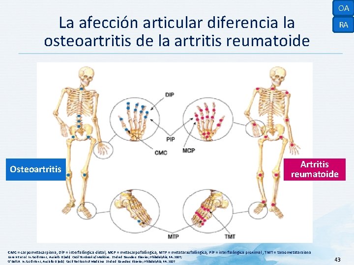 La afección articular diferencia la osteoartritis de la artritis reumatoide Osteoartritis OA RA Artritis