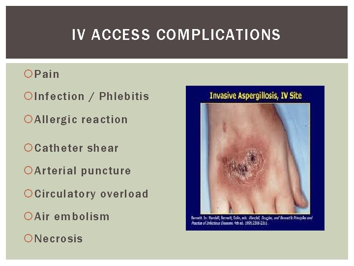 IV ACCESS COMPLICATIONS Pain Infection / Phlebitis Allergic reaction Catheter shear Arterial puncture Circulatory