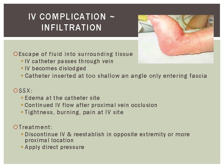 IV COMPLICATION ~ INFILTRATION Escape of fluid into surrounding tissue § IV catheter passes