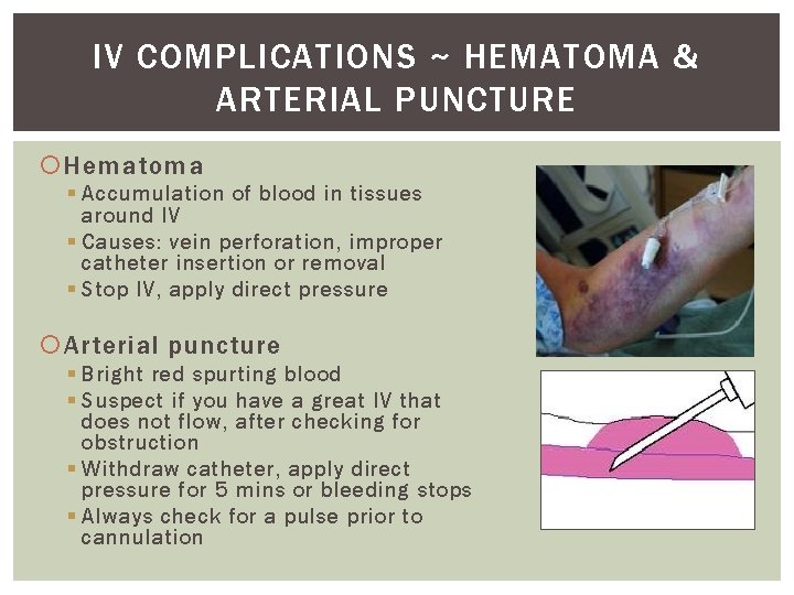 IV COMPLICATIONS ~ HEMATOMA & ARTERIAL PUNCTURE Hematoma § Accumulation of blood in tissues