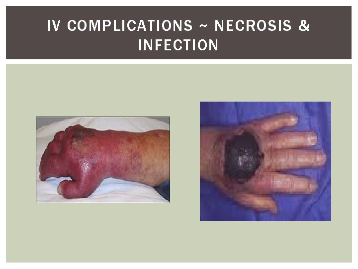 IV COMPLICATIONS ~ NECROSIS & INFECTION 