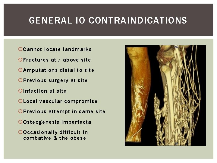 GENERAL IO CONTRAINDICATIONS Cannot locate landmarks Fractures at / above site Amputations distal to