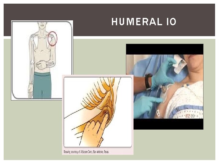 HUMERAL IO 