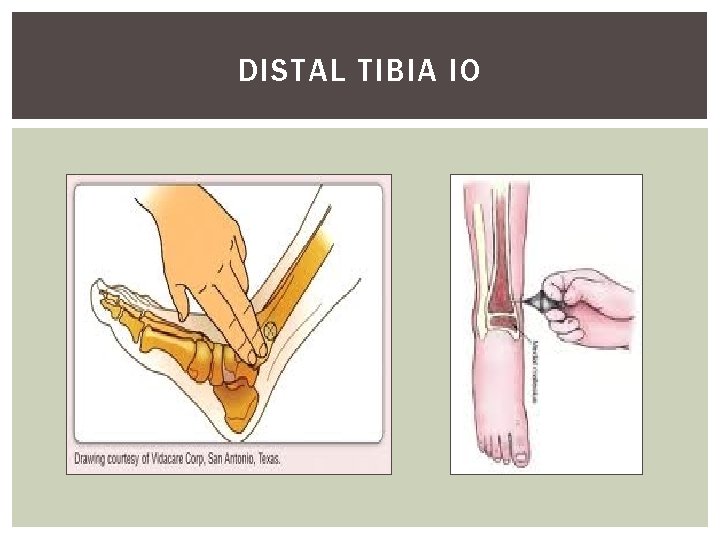 DISTAL TIBIA IO 