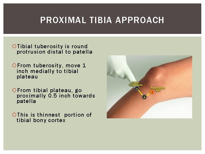 PROXIMAL TIBIA APPROACH Tibial tuberosity is round protrusion distal to patella From tuberosity, move