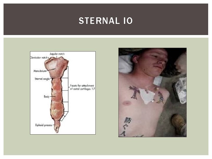 STERNAL IO 