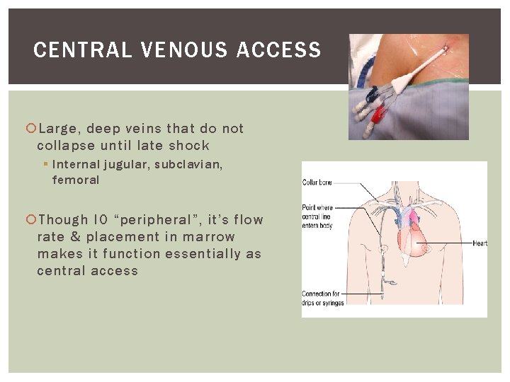 CENTRAL VENOUS ACCESS Large, deep veins that do not collapse until late shock §