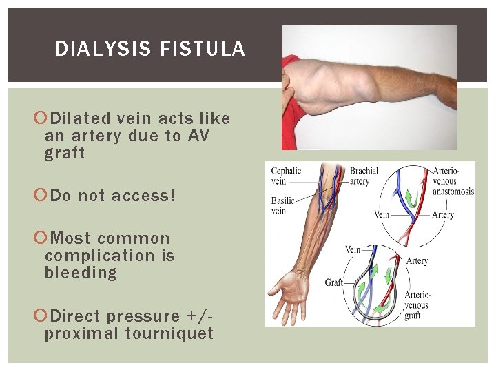 DIALYSIS FISTULA Dilated vein acts like an artery due to AV graft Do not