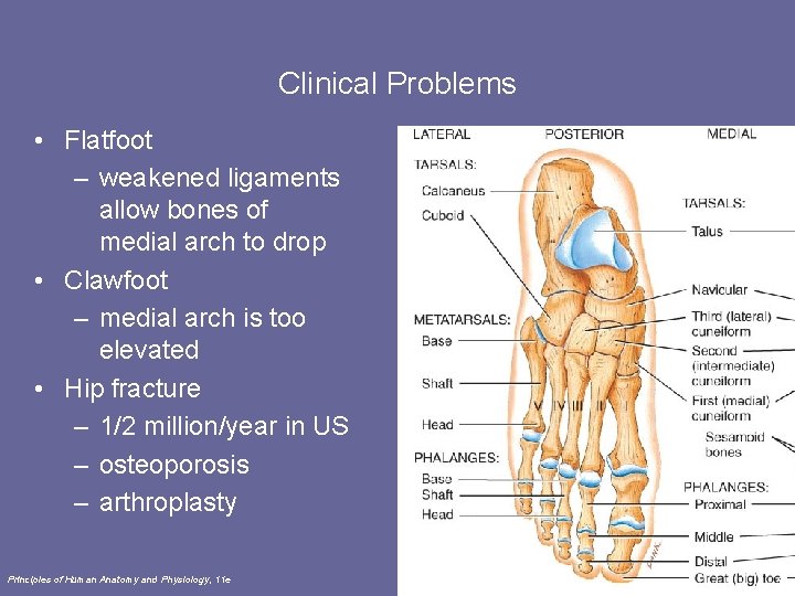 Clinical Problems • Flatfoot – weakened ligaments allow bones of medial arch to drop
