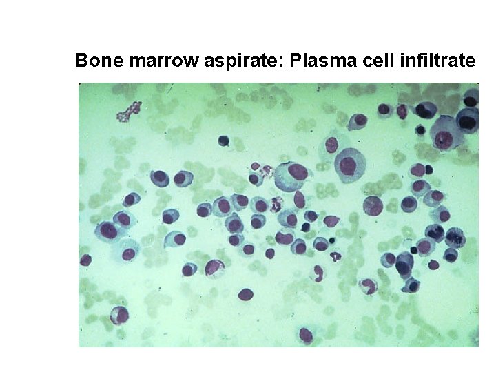 Bone marrow aspirate: Plasma cell infiltrate 