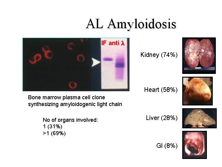 AL Amyloidosis IF anti l Kidney (74%) Heart (58%) Bone marrow plasma cell clone