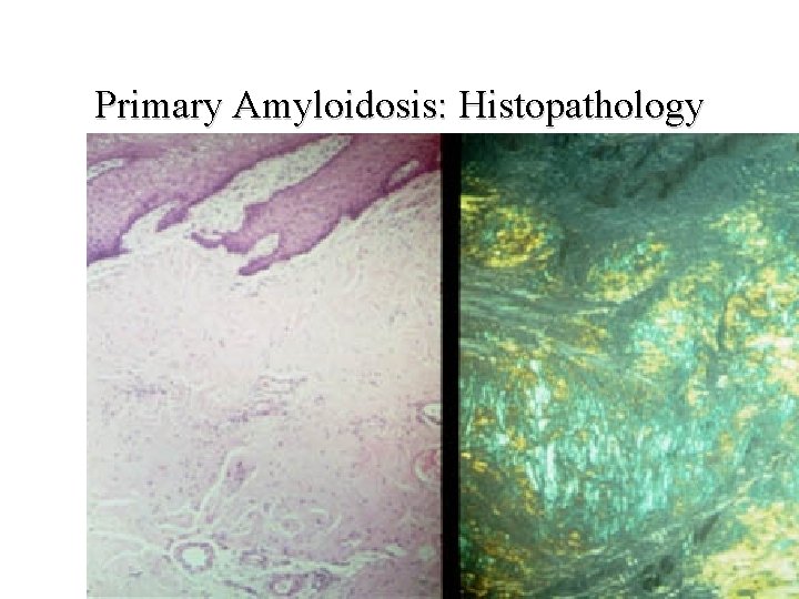 Primary Amyloidosis: Histopathology 