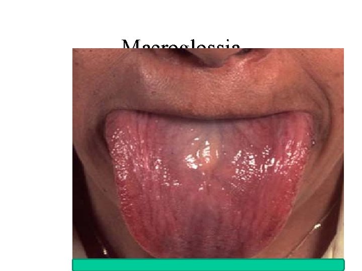 Macroglossia 